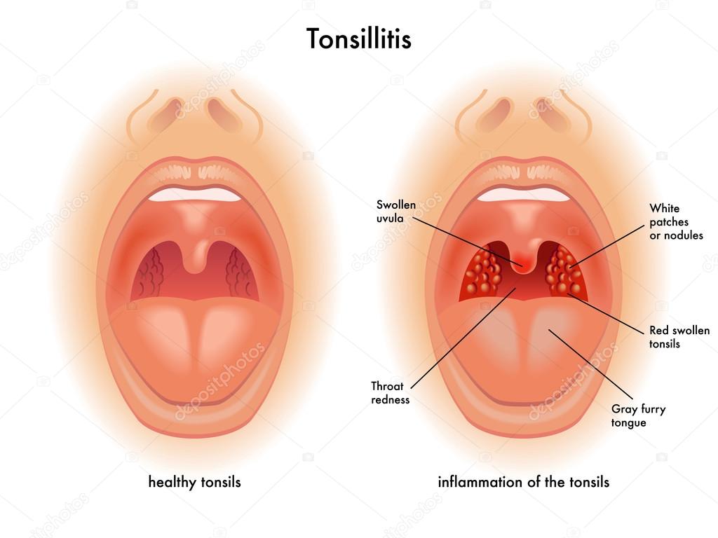 Detailed human Tonsillitis