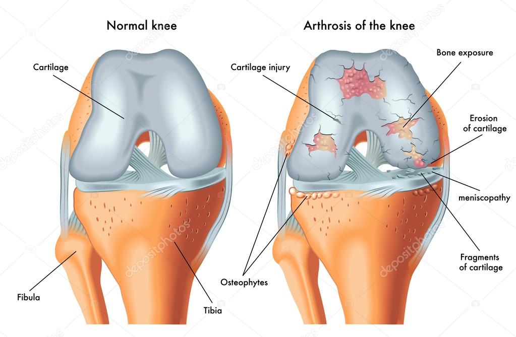 Human Arthrosis of knee