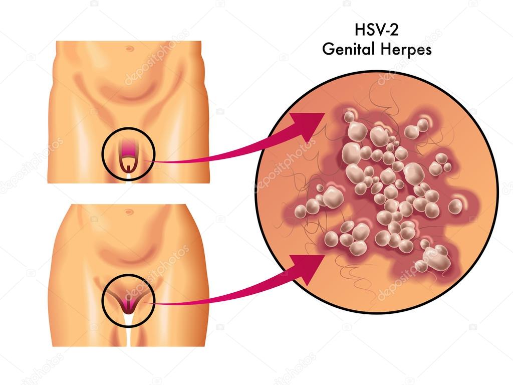Herpeszes prostatitis (prosztata herpesz) tünetek és kezelés