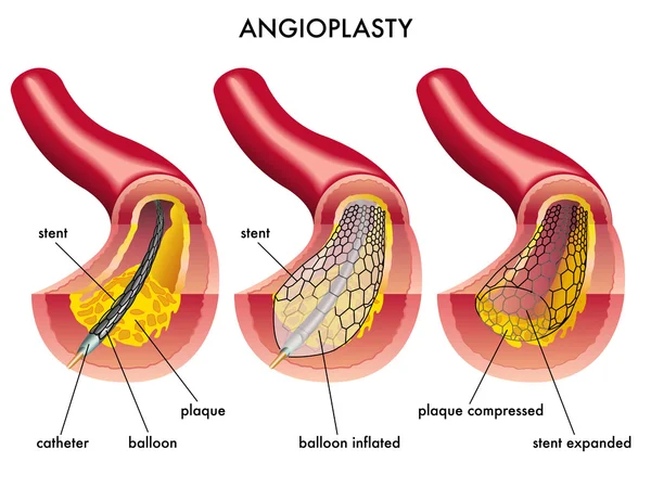 Beyaz bir arka plan üzerinde stent anjiyoplasti