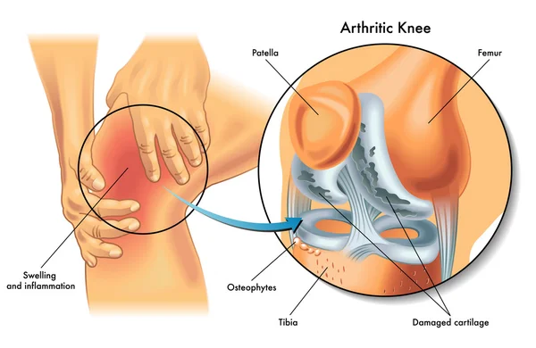 Human knee joint — Stock Vector