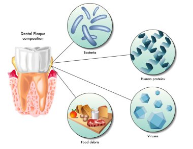 İnsan dişeti iltihabı