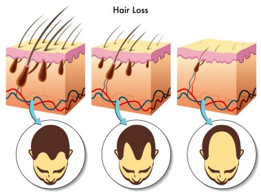 Hair loss process clipart
