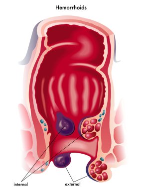 İç ve dış hemoroid.