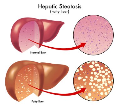 Hepatic Steatosis clipart