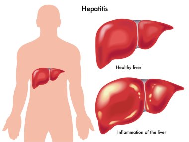 Hepatitis -  human liver anatomy clipart
