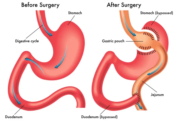 Gastric bypass — Stock Vector