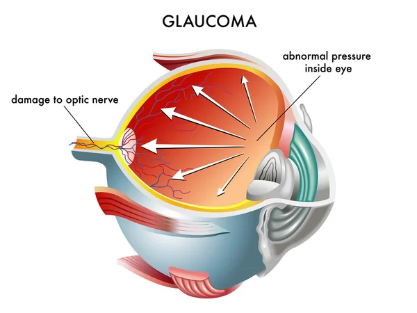 Anatomia ocular do glaucoma —  Vetores de Stock