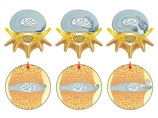 Prolapse of intervertebral disc closeup. — Stock Vector