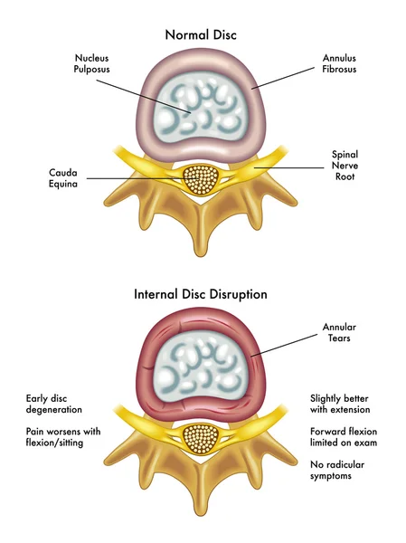Prolapse of intervertebral disc closeup. — Stock Illustration Prolapse of intervertebral disc closeup. Vector Graphics