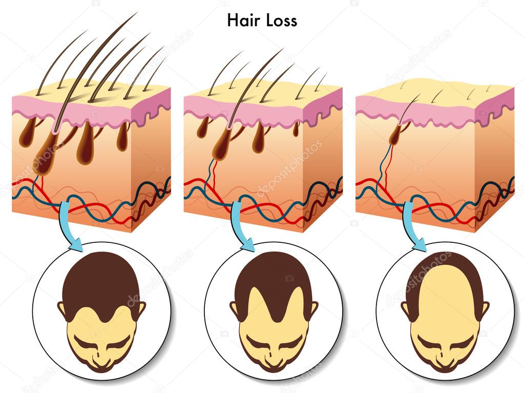 Hair loss process Stock Vector Image by ©rob3000 65090937