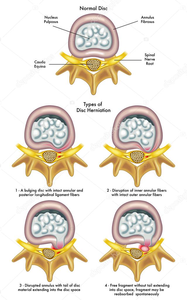 Injury to the spinal nerve