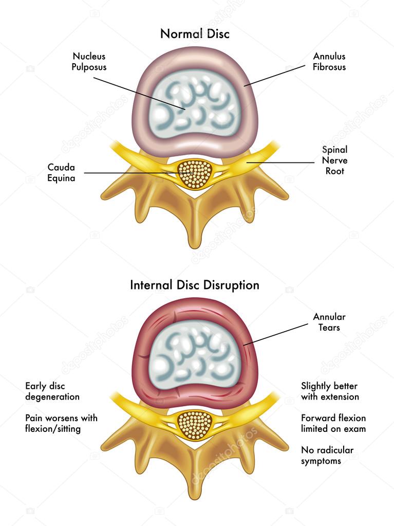 Prolapse of intervertebral disc closeup.