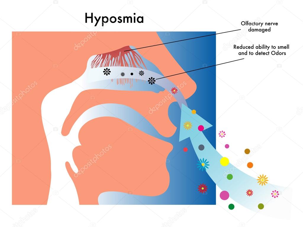 Medical illustration of symptoms of hyposmia