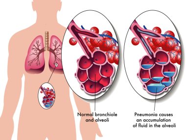 Pneumonia clipart