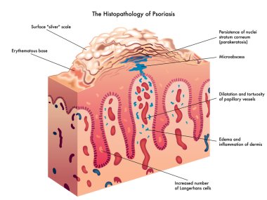 Psoriasis clipart