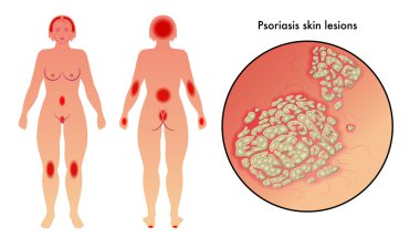 Psoriasis clipart