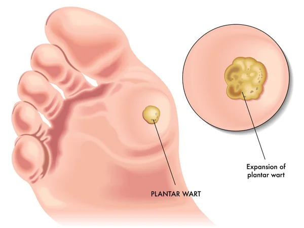 Verrue plantaire — Image vectorielle