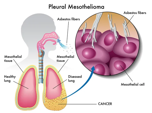 Mesotelioma pleural — Vetor de Stock