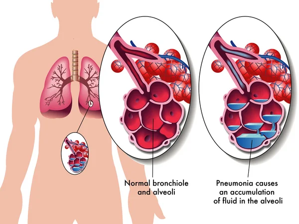 Pneumonia — Stock Vector