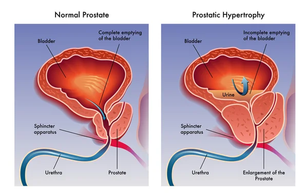 Prostatic hypertrophy — Stock Vector