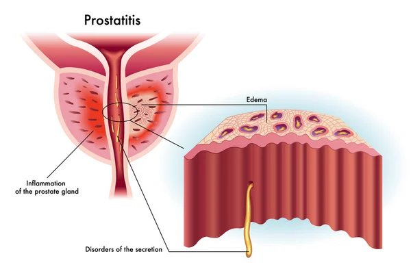 Zapalenie prostaty — Wektor stockowy