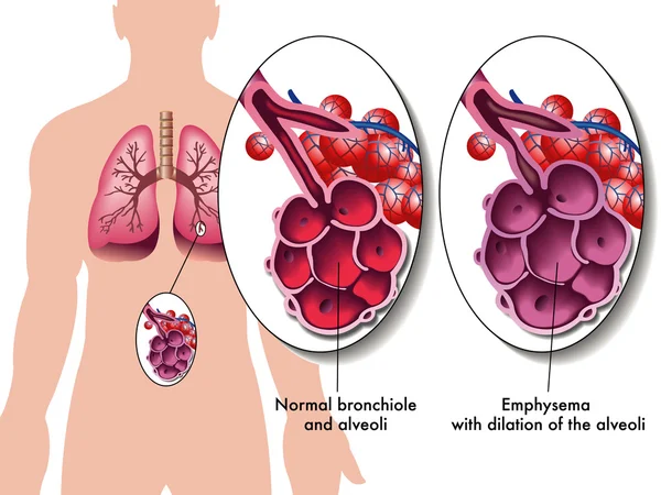 Pulmonaire emfyseem — Stockvector