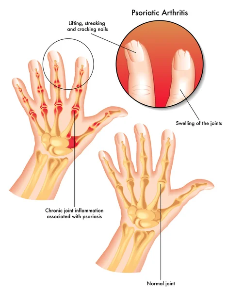 Psoriatic arthritis — Stock Vector