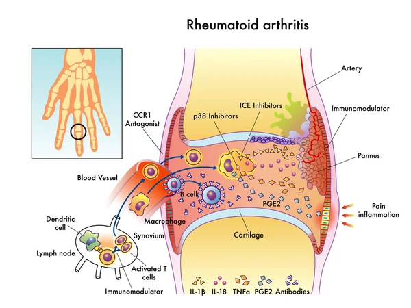 Romatoid artrit — Stok Vektör