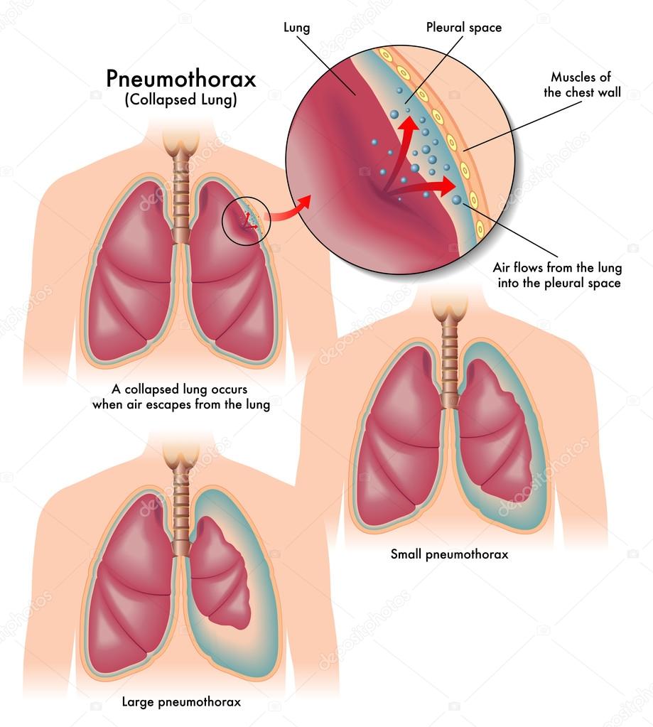 Pneumothorax Stock Vector Image by ©rob3000 #65937185