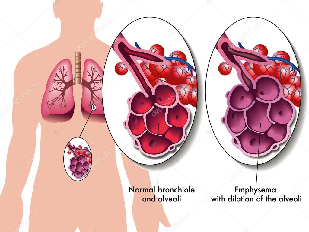 Pulmonary emphysema