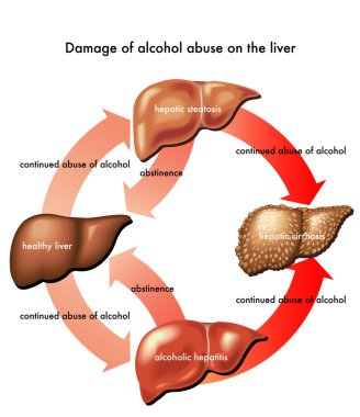Liver and alcohol scheme clipart