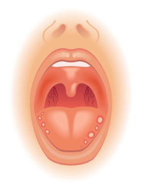 Tongue sores scheme clipart