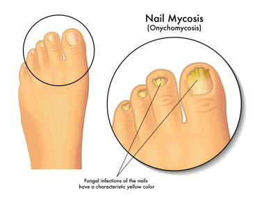 Nail Mycosis scheme clipart