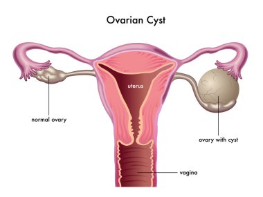 Ovarian cyst scheme clipart