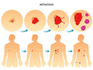 colorful Metastasis scheme clipart