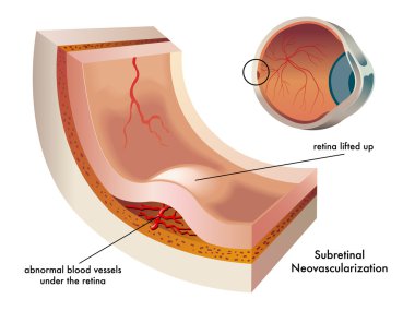 Subretinal neovascularization scheme clipart