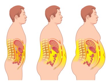 colorful Obesity scheme clipart