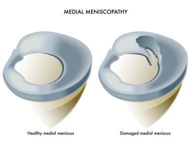 medial meniscopathy scheme clipart