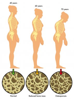 renkli Osteoporoz düzeni