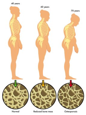 colorful Osteoporosis scheme clipart