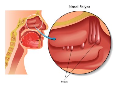Nasal polyps scheme clipart