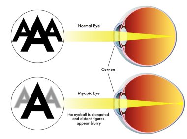 colorful Myopia scheme clipart