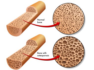 renkli Osteoporoz düzeni