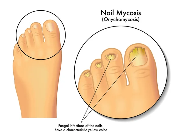 Esquema de micosis de uñas — Vector de stock