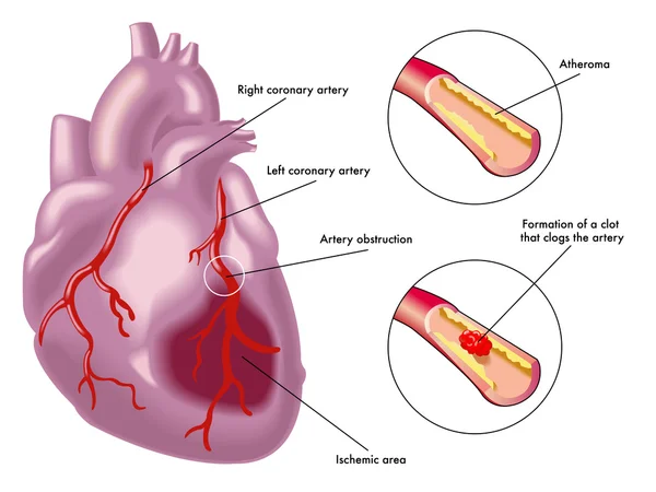 Myocardial infarction scheme — Stock Vector