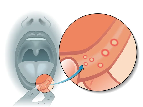 Mouth sores scheme — Stock Vector