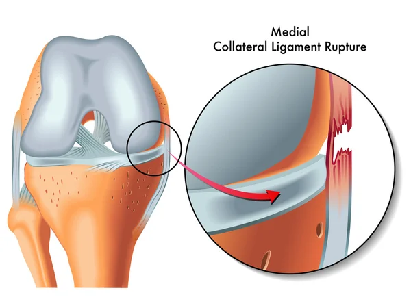 Ruptura del ligamento colateral medial — Vector de stock