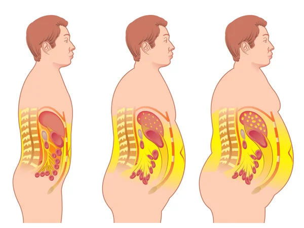 Colorido esquema de obesidad — Archivo Imágenes Vectoriales