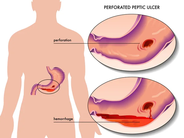 Perforovaný peptický vřed — Stockový vektor